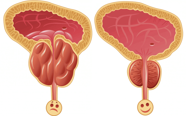 príčiny problémov s potenciou u mužov